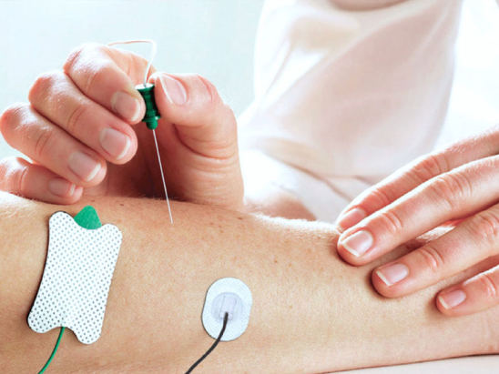 NCD Neuroconducción Motora y Sensitiva