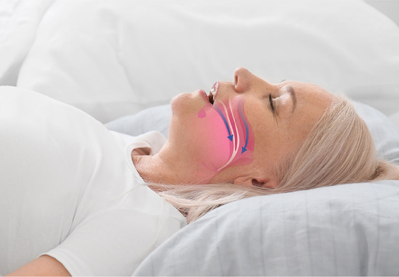 Apnea Obstructiva del Sueño