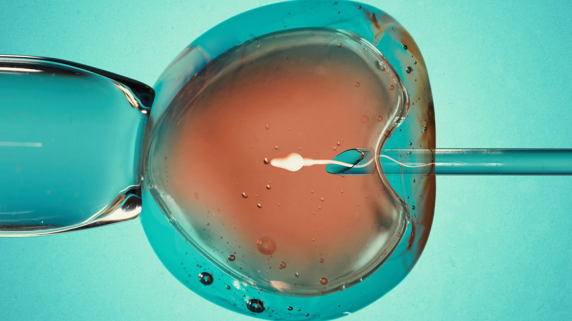 Inyección intracitoplasmática de espermatozoide (ICSI)