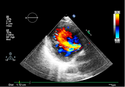 Ecocardiograma Doppler Color