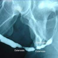 Estenosis uretral